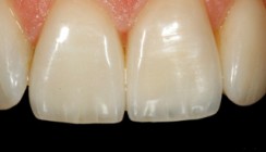 Vollkeramik in der Praxis: Ästhetisch und wirtschaftlich