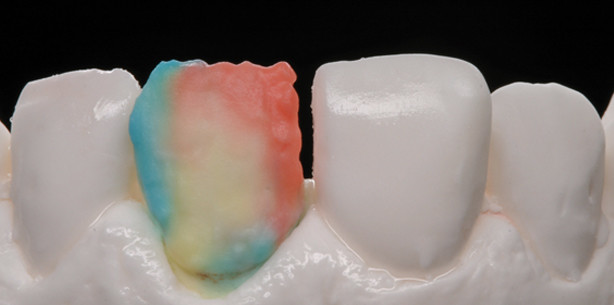 Handarbeit: Die Herstellung eines Veneers