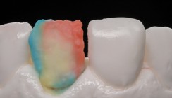 Handarbeit: Die Herstellung eines Veneers