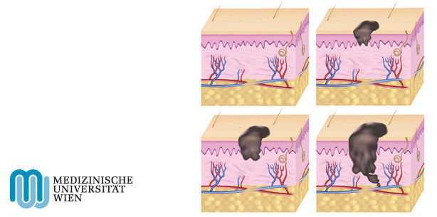 Hautkrebs: Protein hemmt Bildung von Metastasen