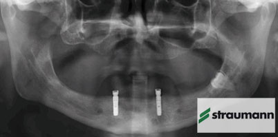 Sehr gute Eigenschaften von Roxolid-Implantaten bestätigt