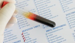 Oralchirurg infizierte Patienten mit Hepatitis C