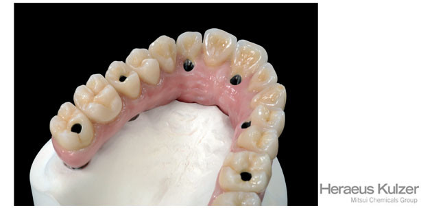 Periimplantitis in der Implantatprothetik