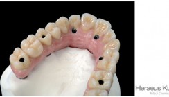 Periimplantitis in der Implantatprothetik