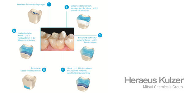 Venus® Mix & Match – Für jede Indikation das ideale Komposit