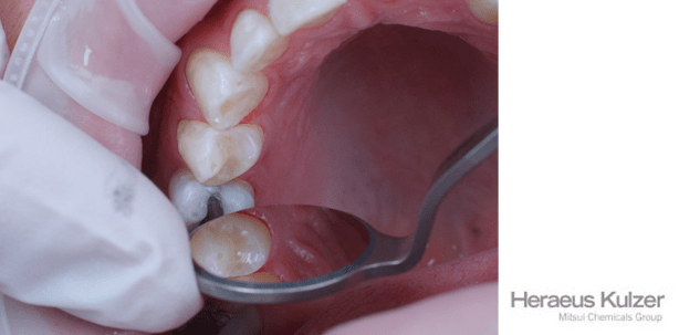 Seitenzahnrestauration schnell und sicher mit Venus® Bulk Fill