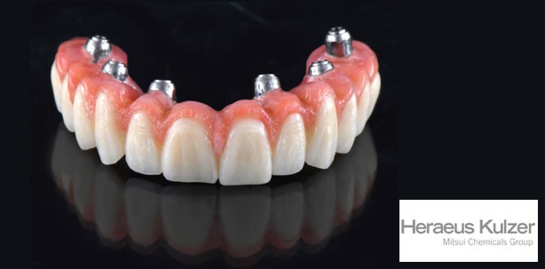 PalaVeneer®/PalaVeneer Dentine zeigen höchste Verbundfestigkeit