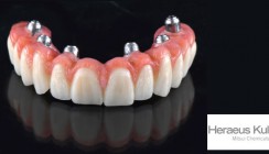 PalaVeneer®/PalaVeneer Dentine zeigen höchste Verbundfestigkeit