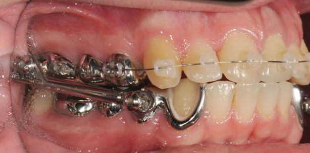 Die Herbst-Apparatur bei Erwachsenen der Angle-Klassen II/1 und II/2
