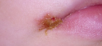 Herpes labialis einfach, schnell und ­nachhaltig therapieren