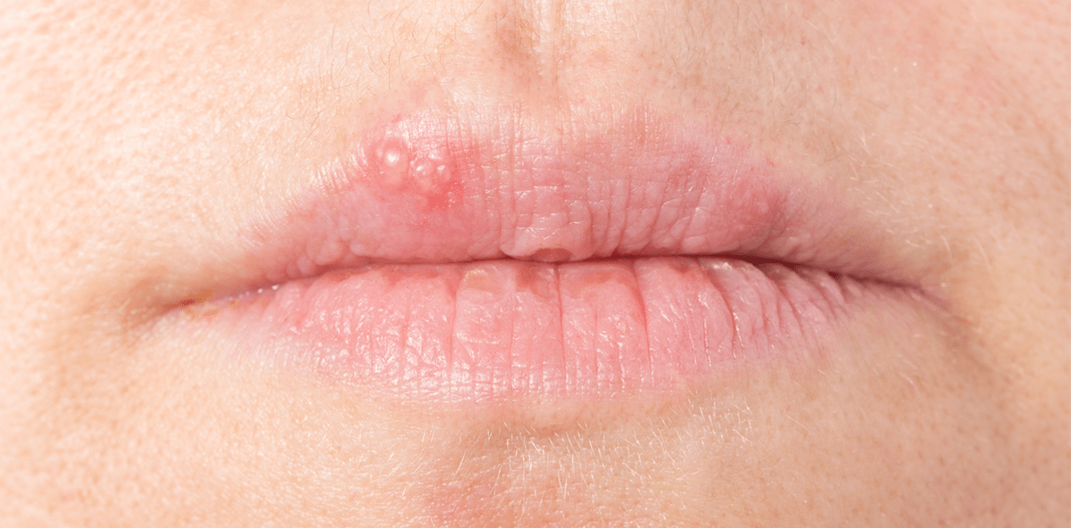 Lippenherpes: Bloß nicht im Urlaub!