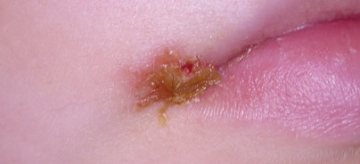 Herpes labialis einfach, schnell und ­nachhaltig therapieren