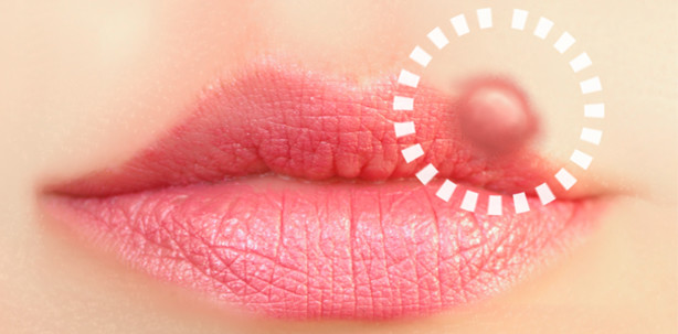 Küssen verboten: Lippenherpes birgt Gefahr für Neugeborene