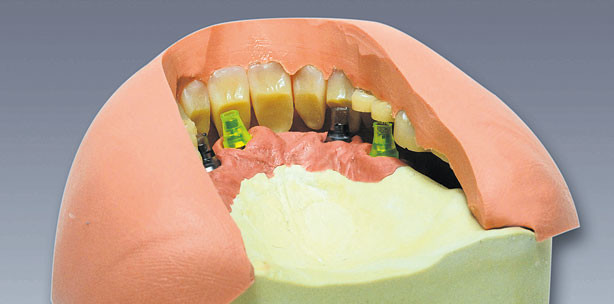 Laborgefertigte Konstruktion als ­Prothesenanker