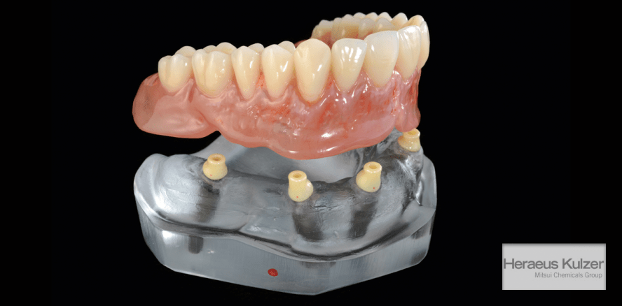 Heraeus Kulzer stellt Indikationserweiterung cara YantaLoc® LV vor