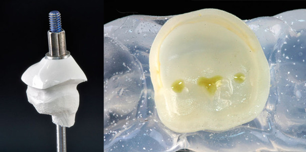 Ästhetische Versorgung mittels Hochleistungskunststoffen