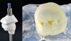 Ästhetische Versorgung mittels Hochleistungskunststoffen