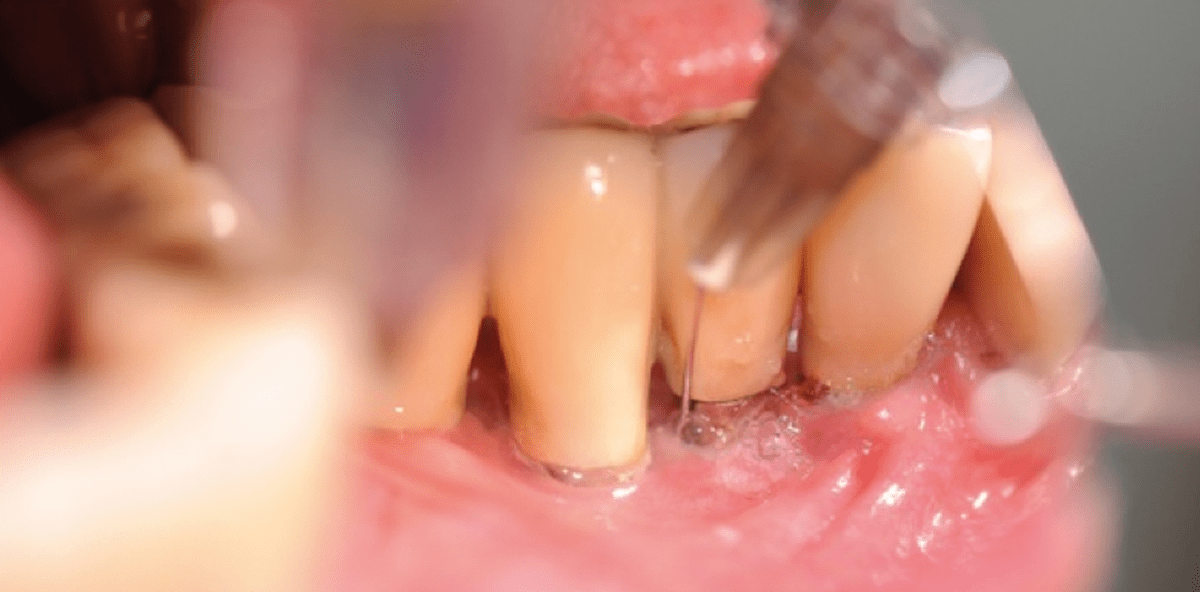 Periimplantitis: Behandlungskonzept mit Hyaluronsäure und Laserlicht