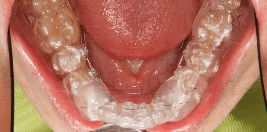 Hybrid-Aligner-Therapie