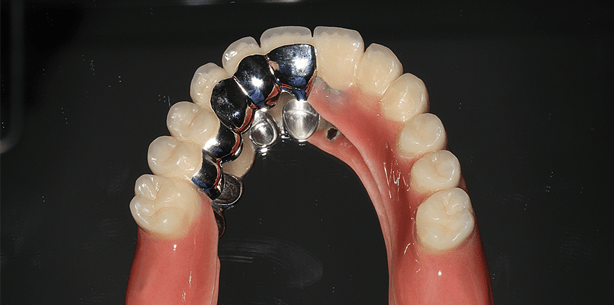 Teleskopierende Hybridprothese auf längenreduzierten Implantaten