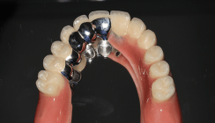 Teleskopierende Hybridprothese auf längenreduzierten Implantaten