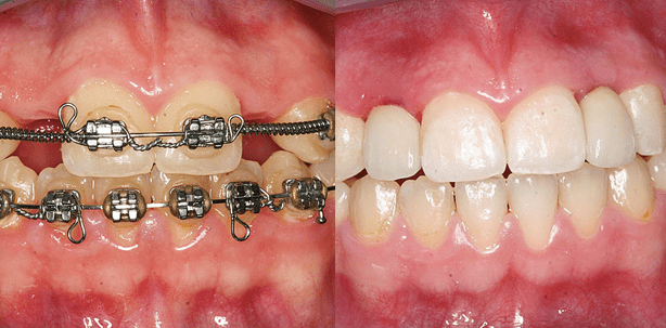 Hypodontie: Kieferorthopädische und implantologische Behandlung