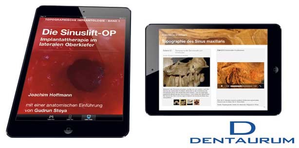 Dentaurum: Erstes multimediales iBook für Implantologen