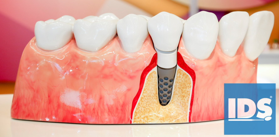 Implantologie auf der Internationalen Dental-Schau (IDS) 2017