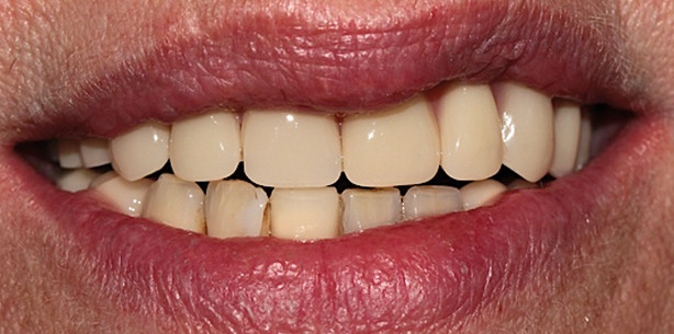 Individuelles Implantat-Training für die Sofortbelastung