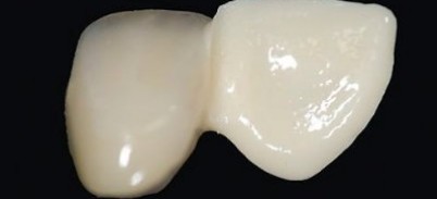 Adhäsive Befestigung von Zirkonoxidrestaurationen