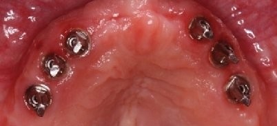 CAD/CAM-gefertigte Suprastrukturen im zahnlosen Kiefer