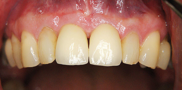 Präimplantologische Magnetextrusion