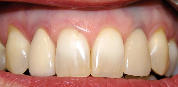 Sofortversorgung von Zahn 22 nach Extraktion