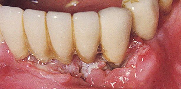 Analyse: Knochenersatzmaterialien ehemaliger Tumorpatienten