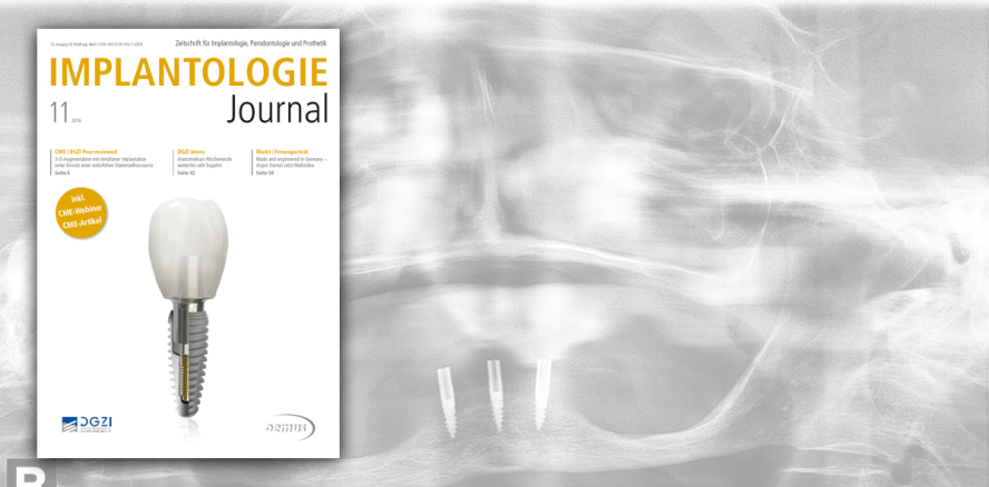 Mit dem aktuellen Implantologie Journal CME-Punkte sammeln