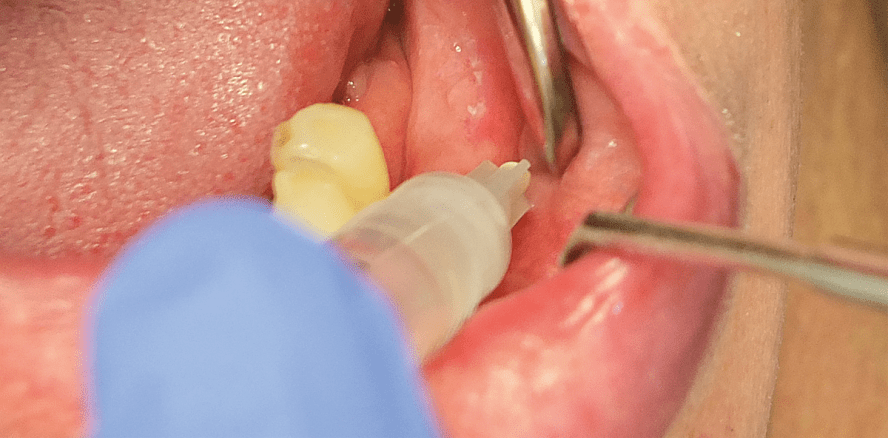 Nervenläsionen vermeiden mit Infiltrationsanästhesie