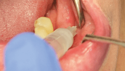 Nervenläsionen vermeiden mit Infiltrationsanästhesie