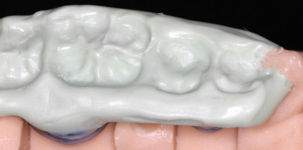 Die modifizierte FGP-Technik