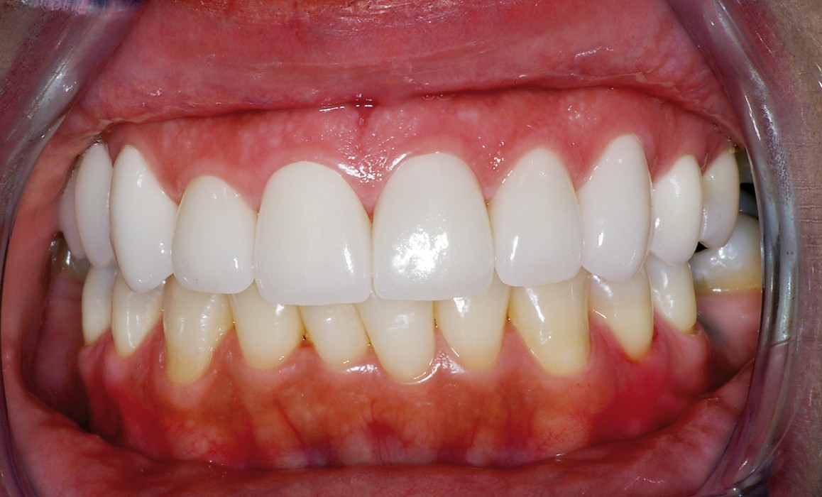 Befestigungszement verfärbt, nicht die Keramik des Veneers