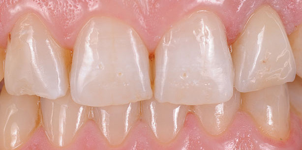 Chirurgisch-prothetische Therapie in der ästhetischen Zone