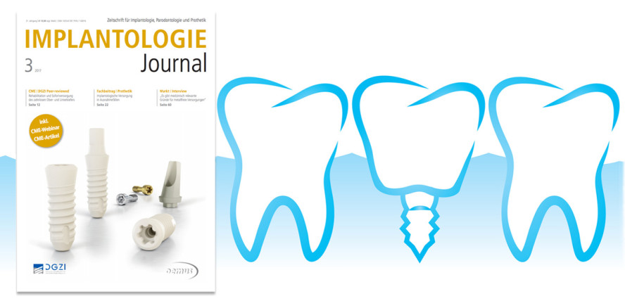 Neueste Ausgabe des Implantologie Journals ist online