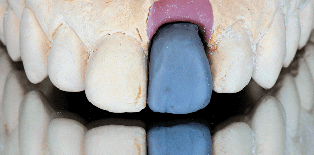 Rot-weiße Ästhetik in der Implantatprothetik