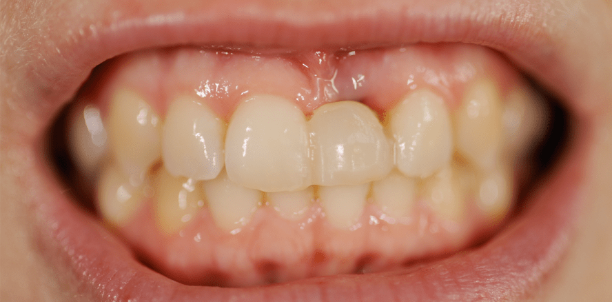 Sofortimplantation mit einteiligen Implantaten