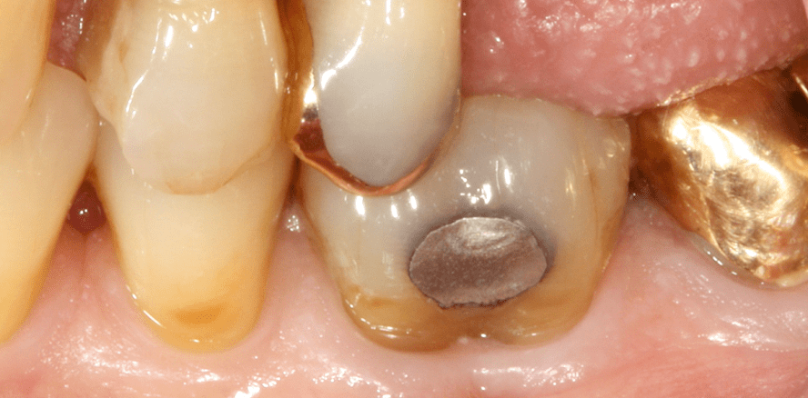 Vom Sinn und Unsinn frühzeitiger Extraktion und Implantation furkationsbefallener Molaren