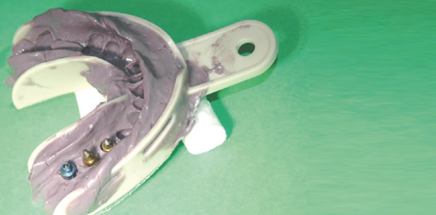 Implantate + Abformung ≠ Kompliziert