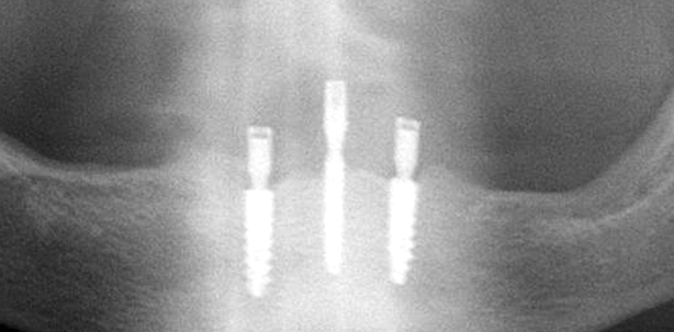 Mehr Lebensqualität für zahnlose Patienten