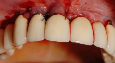 Ein neues Konzept bei Periimplantitis