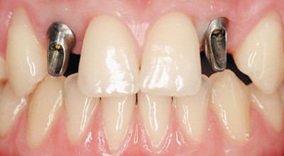 Korrekturmöglichkeiten bei ungünstigen Implantatpositionen in der Oberkieferfront