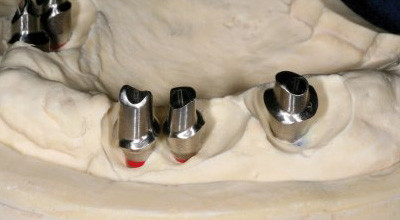 Implantatgetragene Keramikstege