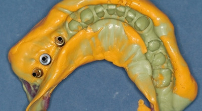 Die Implantatabformung –  drei Techniken im Überblick